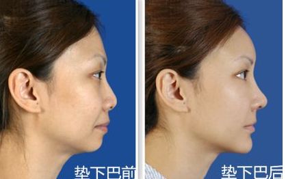 上海九院鼻部整形手術專家李圣利，專業(yè)水準如何？