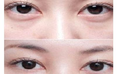 北京張笑天的下頜角手術(shù)技術(shù)及豐碩成果曝光！醫(yī)術(shù)精湛，案例展示震撼人心