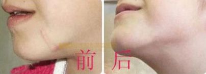 上海哪家醫(yī)院有專業(yè)的唇裂手術(shù)醫(yī)生？治療兔唇患者的必備信息！