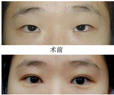 成都比較好的雙眼皮整形醫(yī)院推薦  七家熱門(mén)整容醫(yī)院名單展示