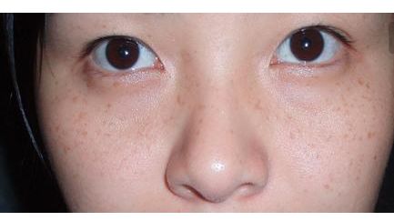 張恒術(shù)雙眼皮手術(shù)80天后效果揭曉，驚喜呈現(xiàn)！