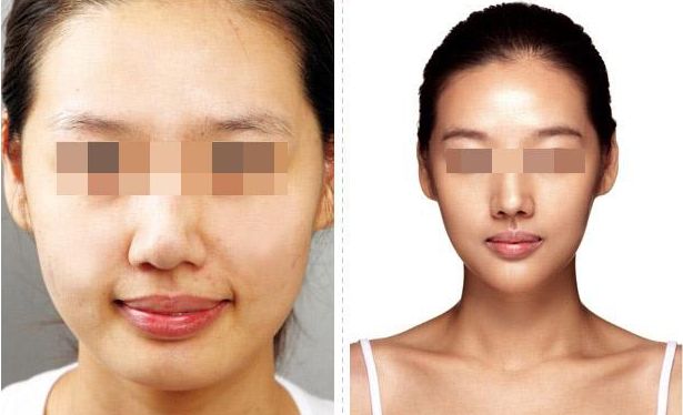 武漢恩娜整形中心：解讀雙眼皮手術(shù)全攻略，案例展示讓你真實了解效果！