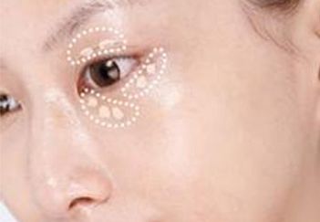 杭州葉秀娣做雙眼皮具體效果如何？專(zhuān)家實(shí)踐案例發(fā)布