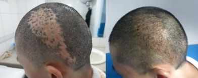 杭州有哪些專業(yè)技術(shù)過硬的鼻修復(fù)醫(yī)院？推薦浙江第二醫(yī)院、薇琳整形醫(yī)院、清鍇醫(yī)療美容中心等