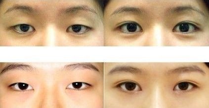 成都雙眼皮修復(fù)醫(yī)生最新名單出爐！頂尖專家蔡玲、王強等領(lǐng)銜榜單
