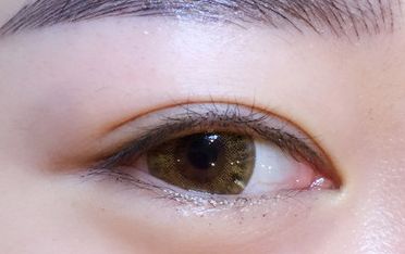 鄒翀，這一雙眼皮技術，近期有所革新