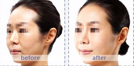 南京脂肪填充整形醫(yī)院推薦，蘇王、維多利亞和康美三家不容錯(cuò)過的選擇