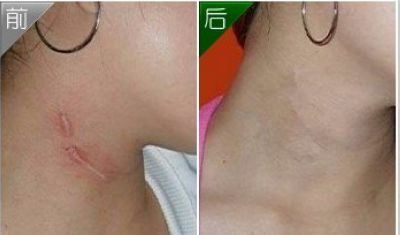 廣州隆胸手術(shù)費用及案例分享，口碑如何？