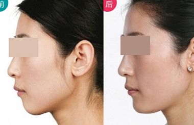 上海哪個(gè)醫(yī)生擅長(zhǎng)鼻翼縮??？2023年度網(wǎng)民口碑推薦醫(yī)生名冊(cè)曝光