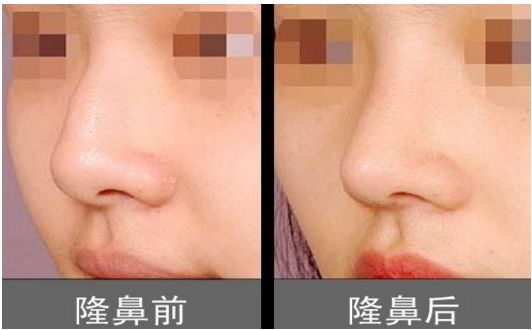 上海柴云醫(yī)生雙眼整形效果完美！手術(shù)前后真實(shí)照片呈現(xiàn)出專業(yè)水平