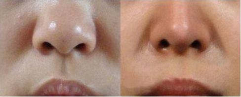 南京哪個醫(yī)生擅長縮胸手術？評價吳國平和金院長的技術