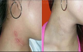北京首都整形醫(yī)院雙眼皮修復效果如何？詳細案例揭秘