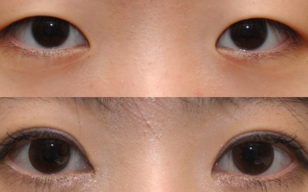 上海哪家醫(yī)院做眼袋手術(shù)價(jià)格實(shí)惠又靠譜？排行榜前十強(qiáng)！