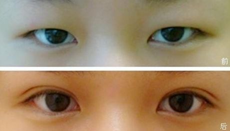 塑造完美鼻型，一觸即達(dá)！隆鼻醫(yī)生品牌推薦，成功案例揭秘，費(fèi)用一覽表震撼來襲