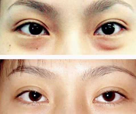 謝錦清：醫(yī)術(shù)高超，雙眼皮案例解析曝光！