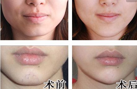 廣州人中縮短手術(shù)醫(yī)生推薦？網(wǎng)友真實評價與信息公開！