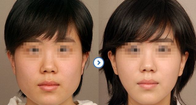 成都隆鼻醫(yī)生排行榜2024：專家推薦的醫(yī)院大揭秘！