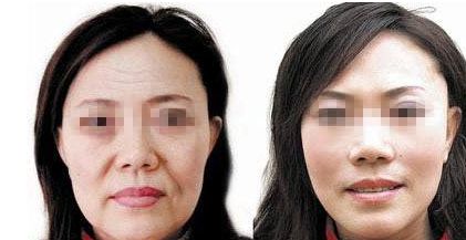成都自然雙眼皮去哪家醫(yī)院靠譜？