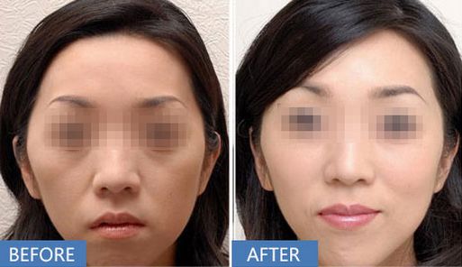 上海哪家醫(yī)院做打玻尿酸除皺效果好？