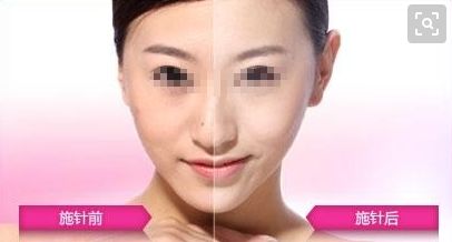 廣州哪家醫(yī)院可以安全進行拉皮手術？