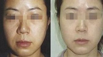 王自謙脂肪移植，存活率高受追捧