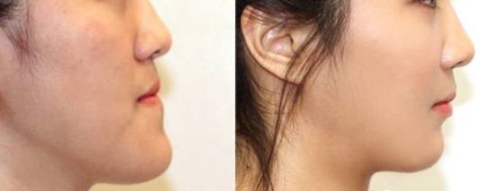 南京施爾美醫(yī)院醫(yī)生案例對(duì)比，讓你信服！