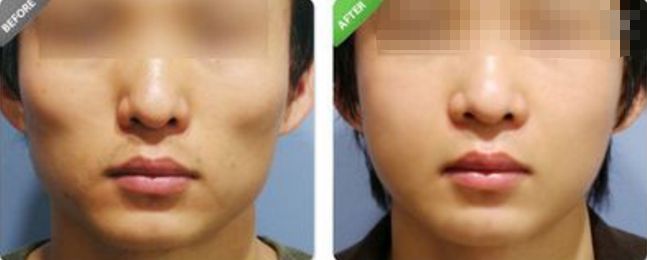 深圳哪家醫(yī)院的拉皮除皺效果最好？排名前幾位的醫(yī)院有哪些？