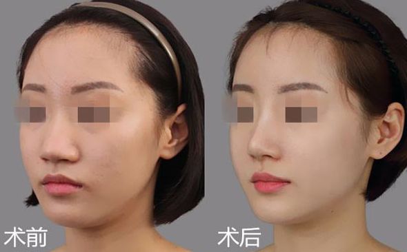 廣州拉皮哪家醫(yī)生技術(shù)比較好？TOP5名醫(yī)大揭秘