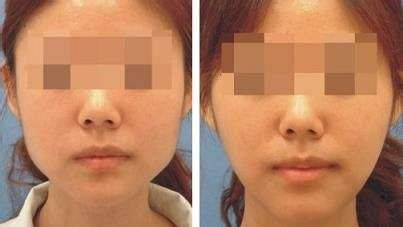 上海哪家醫(yī)院的下巴隆鼻手術(shù)效果最好？