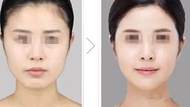 長沙雙眼皮整形醫(yī)院推薦，哪家效果更好？
