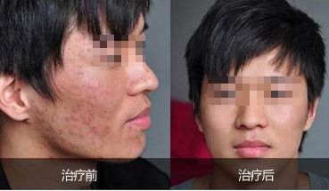 重慶吸脂哪家好？華美吸脂專家經(jīng)驗(yàn)豐富，安全保障