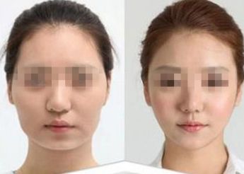 南寧市哪家醫(yī)院做雙眼皮好？