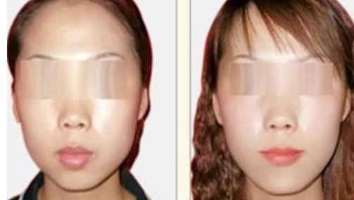 荊州哪個(gè)醫(yī)院能做隆鼻手術(shù)效果好？