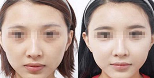 邯鄲哪家醫(yī)院做乳房整形效果好？