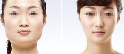 咸陽哪家醫(yī)院做雙眼皮好？醫(yī)院推薦！
