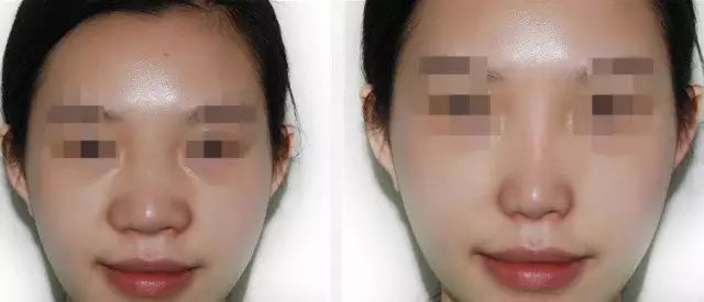 哈爾濱哪家醫(yī)院做隆鼻好？醫(yī)療技術(shù)排行幫你快速選擇