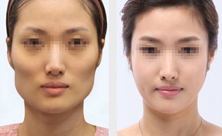 深圳隆胸醫(yī)院推薦：專業(yè)經(jīng)驗(yàn)豐富、口碑好的醫(yī)院