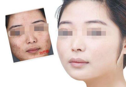 廣州肚皮上的妊娠紋如何有效修復(fù)？