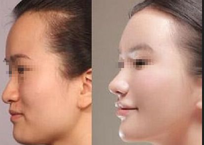 成都恒博植發(fā)效果如何？真實(shí)案例分享與價(jià)格分析