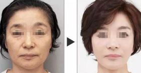 西安哪家醫(yī)院擅長面部輪廓整形？