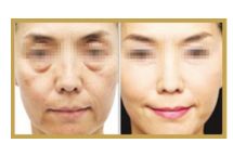 日照哪家醫(yī)院做雙眼皮手術(shù)技術(shù)高效？