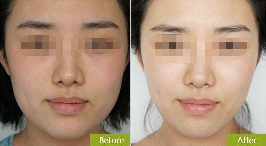 杭州哪家醫(yī)院能夠安全而有效地進(jìn)行隱形矯正？