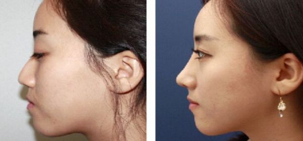 北京大腿抽脂專家推薦，哪個(gè)醫(yī)院技術(shù)好？