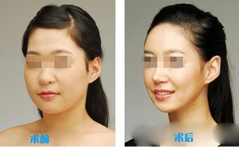 肌功能矯治，哪個階段適合兒童早期干預(yù)？哪些醫(yī)院堪稱專家？