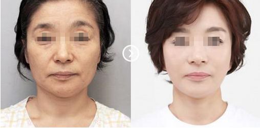 蘇州奧克拉醫(yī)院的整形效果及評價(jià)如何？