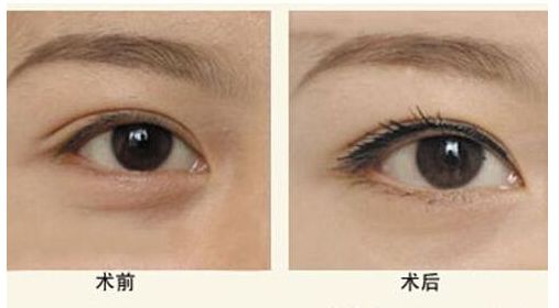 山東哪家醫(yī)院做膨體隆鼻效果好？