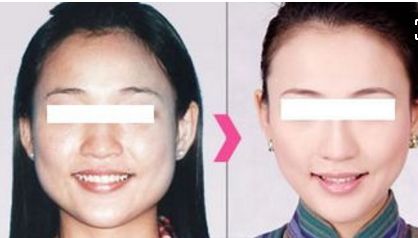 重慶華美分層抗衰超聲炮體驗:效果和醫(yī)生技術(shù)分析 重慶華美分層抗衰超聲炮體驗:效果和醫(yī)生技術(shù)分析