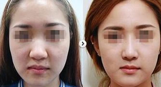上海愛爾眼科醫(yī)院近視眼視力矯正方案解析：技術(shù)、價格、醫(yī)生介紹全攻略
