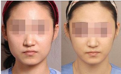 蘭州鼻子整形效果如何？