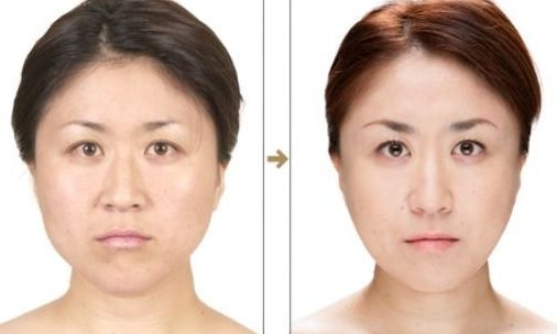 上海美聯(lián)臣吸脂怎么樣？真實(shí)案例告訴你答案！